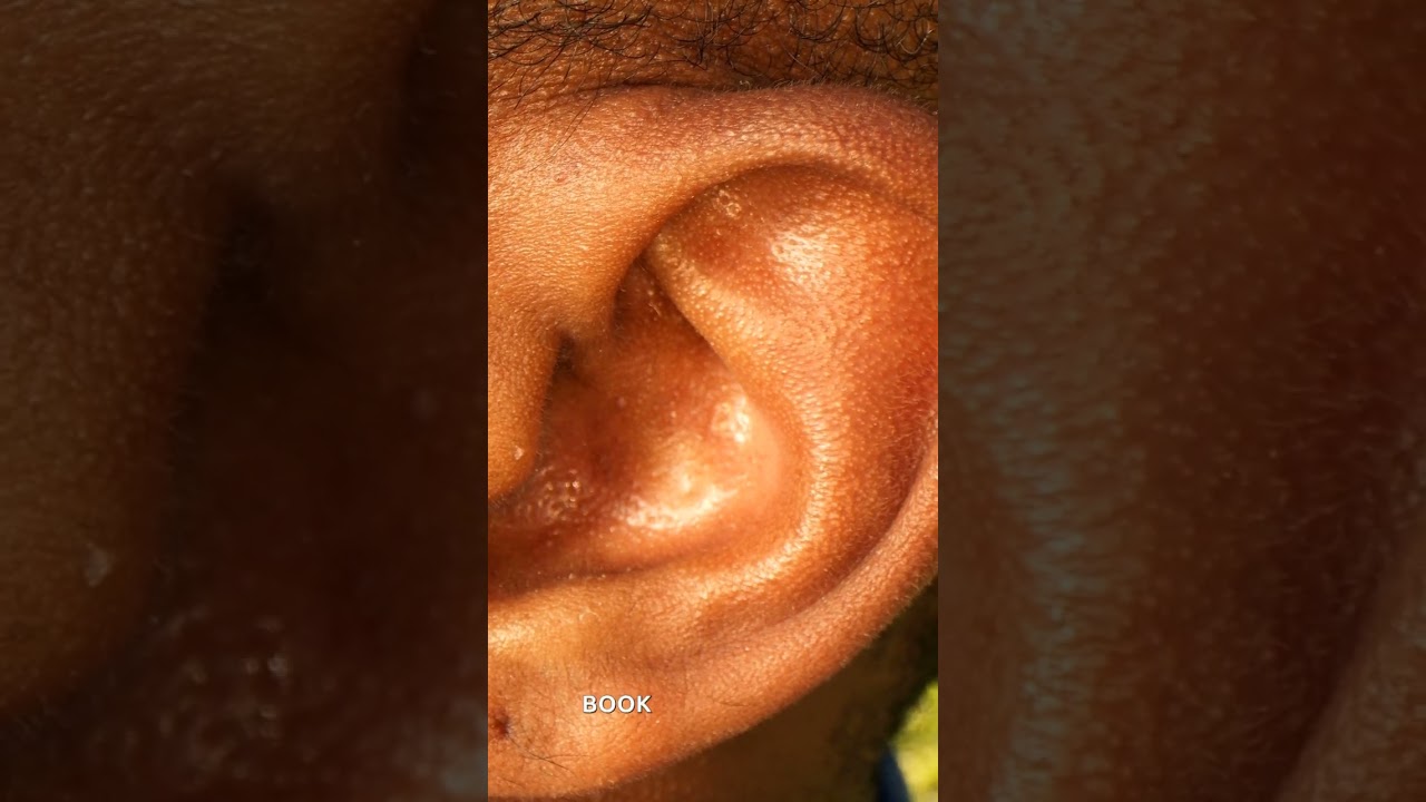Golders Green, Hendon, Temple Fortune: The Ultimate Guide to Microsuction Ear Wax Removal